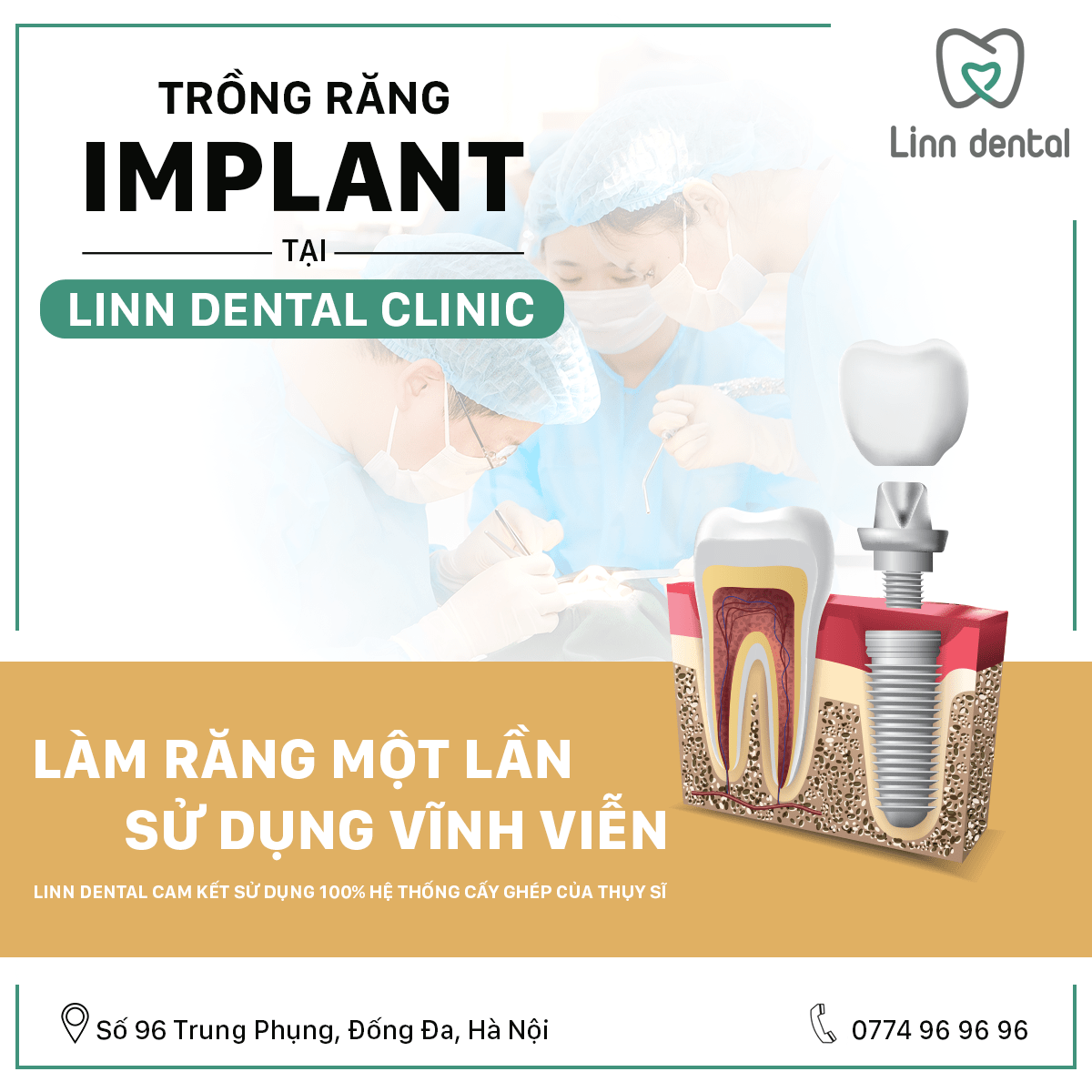 cấy ghép implant