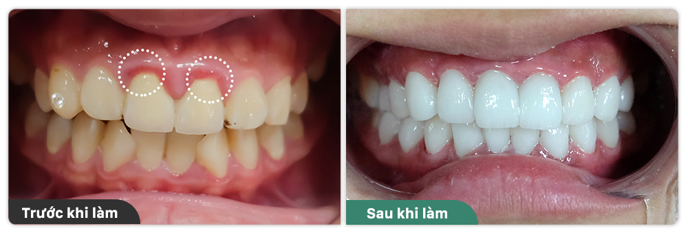 Điều trị viêm lợi