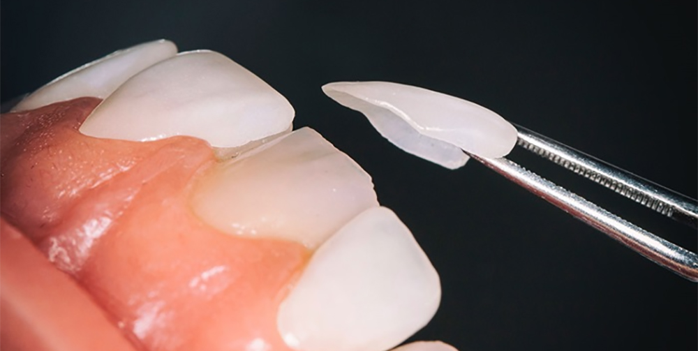 Dán sứ Veneer chỉ mài một lới rất mỏng trên bề mặt ngoài của răng (từ 0.01 - 0.03 mm)