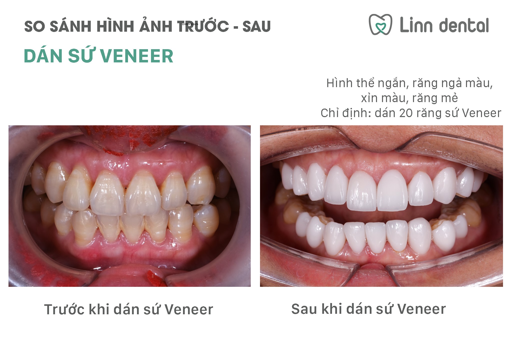 Kết quả Trước và Sau khi làm dán sứ veneer tại Linn Dental
