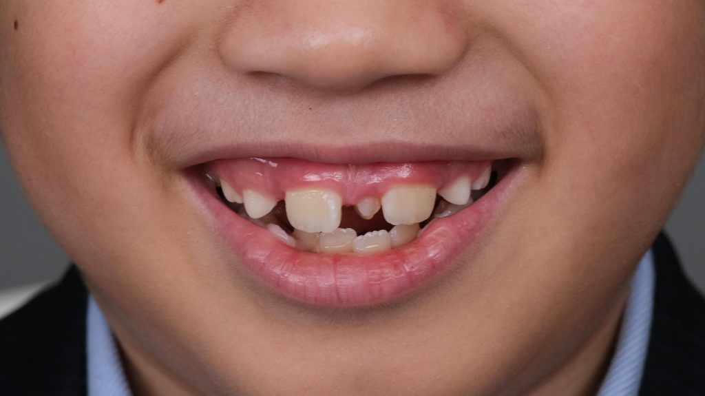 Niềng răng Invisalign