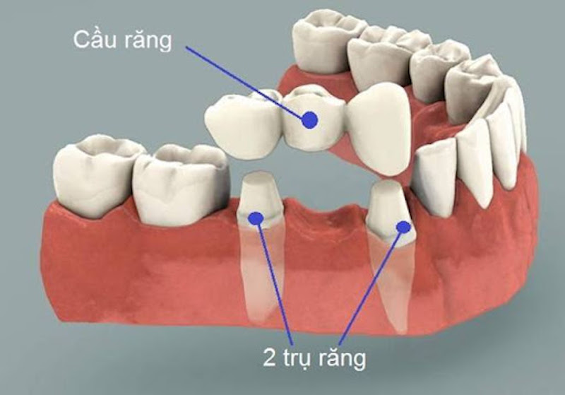 cầu răng