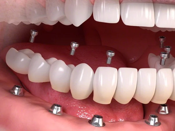 cấy ghép implant