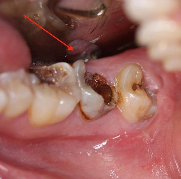 Răng hàm bị sâu lung lay có nên nhổ không? Tìm hiểu và giải pháp tối ưu